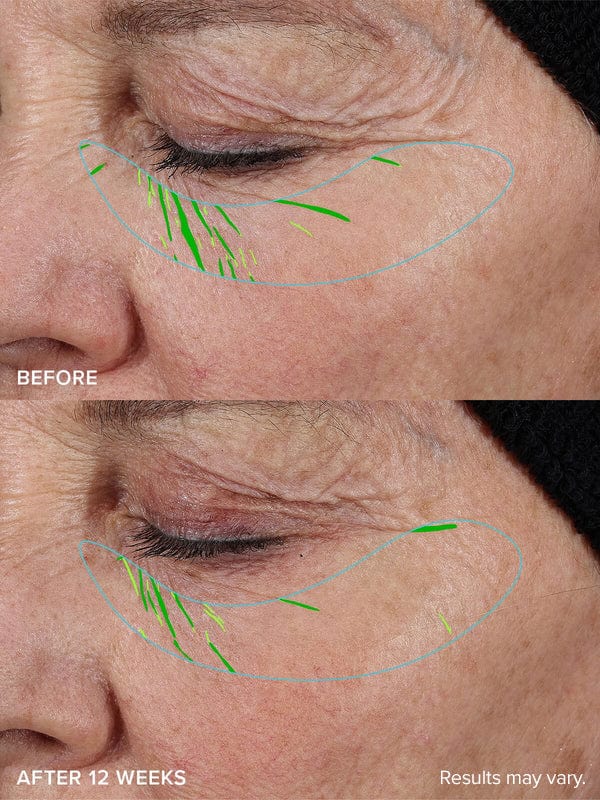 Needle-less Growth Factor Serum